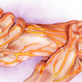 Can neuropathy be reversed naturally