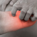 What are the stages of neuropathy?